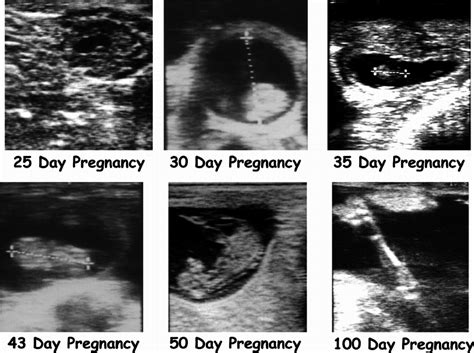 stages of pregnancy ultrasound